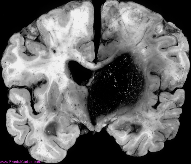 Hypertensive thalamic hemorrhage